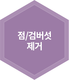 점/검버섯 제거